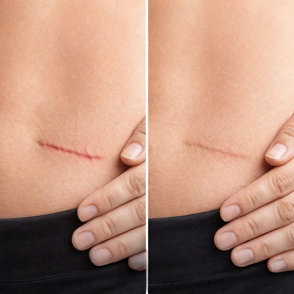 Spray Cicatrizante ScarRemove®