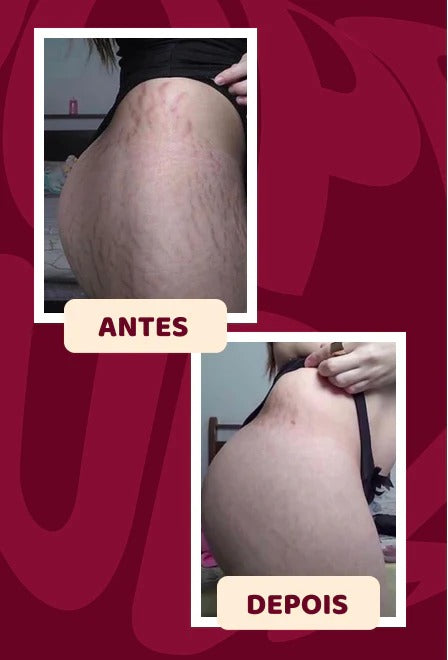POPOZUDA - ELIMINA CELULITIS Y ESTRÍAS