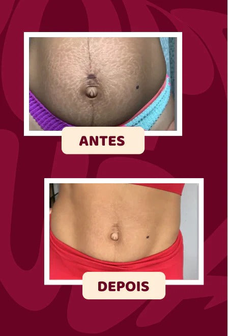 POPOZUDA - ELIMINA CELULITIS Y ESTRÍAS